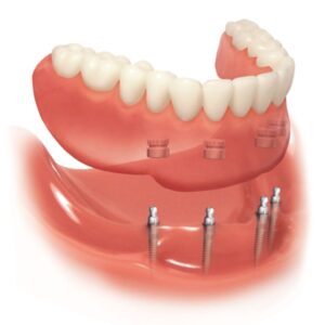 implantes dentales MDL