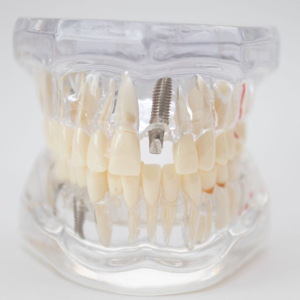 implantes dentales