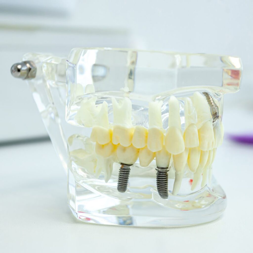 ¿Cuándo deberías optar por un tratamiento con implantes dentales?